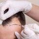 Mann während der Vorbereitung zur Haartransplantation in Frankfurt